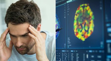 Man had splitting headaches for years with no answer—until an MRI uncovered the cause and stunned even doctors