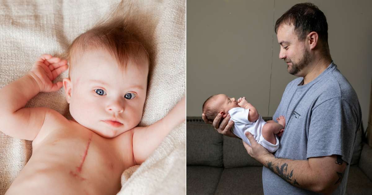 (L) Infant with scar across chest from surgery. (Representative Cover Image Source: Getty Images| Eleonora_os), (R) Dad holding newborn and affectionately gazing at him. (Representative Cover Image Source: Pexels| Legacy Shots by Sharan Sathya)