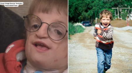 7-yr-old was born with deformed jaw struggled to eat or breathe — then doctors used his ribs to help him breathe