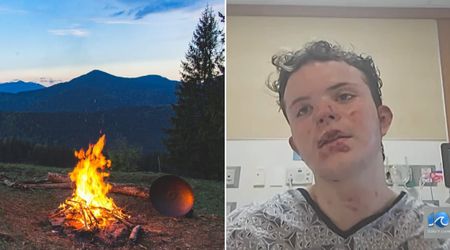 17-yr-old freaked out when a fireball from the bonfire 'hit' him square in the face — his instinctive action may have saved his life