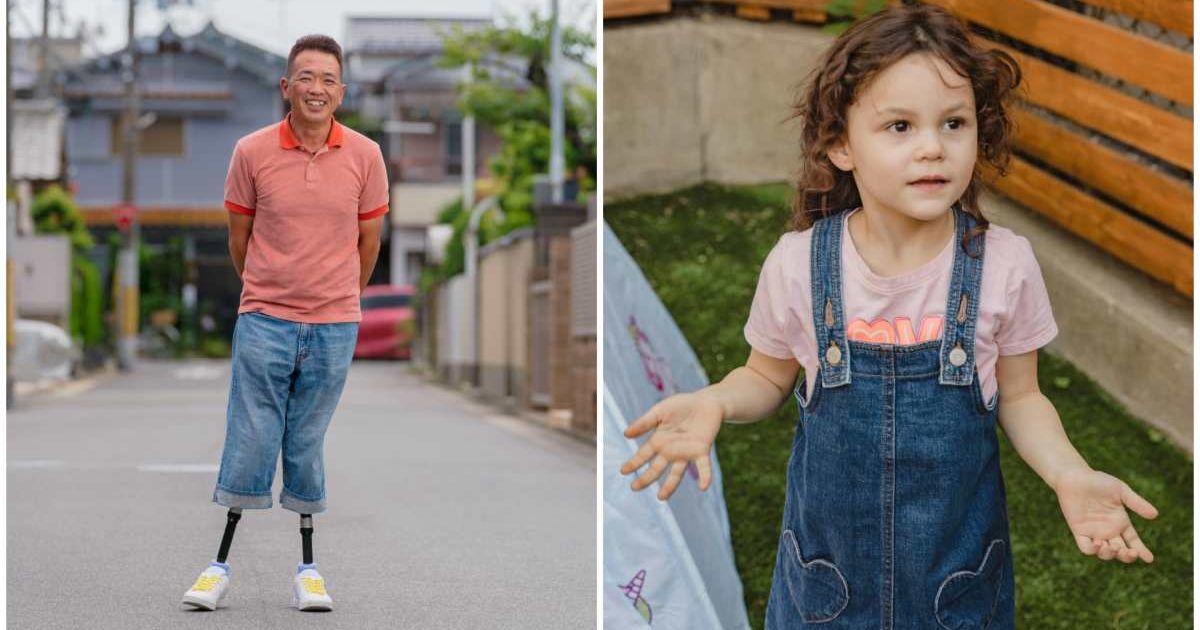 (L ) A double amputee ; (R) A little girl shrugging (Representative Cover Image Source: (L) Getty Images; (R) Pexels | Photo by (L) JGalione; (R) RDNE Stock project )