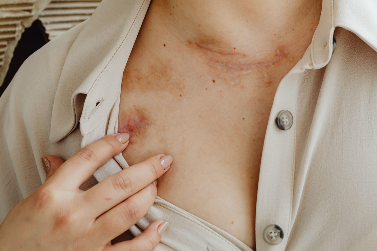 A woman is examining rashes on her neck.